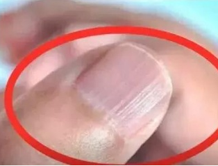 蘑菇视频成人网站免费厂家分析手指甲有竖纹的根本原因 蘑菇视频成人网站免费厂家分析手指甲有竖纹的根本原因
